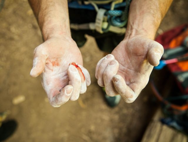 rough-hands-with-a-cut-bleeding-finger